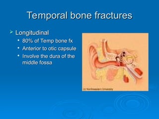 Temporal bone fractures
Temporal bone fractures
 Longitudinal
Longitudinal

80% of Temp bone fx
80% of Temp bone fx

Anterior to otic capsule
Anterior to otic capsule

Involve the dura of the
Involve the dura of the
middle fossa
middle fossa
 