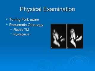 Physical Examination
Physical Examination
 Tuning Fork exam
Tuning Fork exam
 Pneumatic Otoscopy
Pneumatic Otoscopy

Flaccid TM
Flaccid TM

Nystagmus
Nystagmus
 