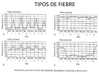 TIPOS DE FIEBRE
 