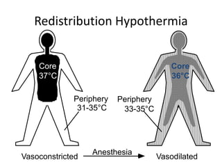 Redistribution Hypothermia
Core
37°C
Vasoconstricted
Periphery
31-35°C
Anesthesia
Periphery
33-35°C
Core
36°C
Vasodilated
 