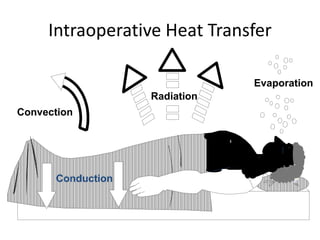 Intraoperative Heat Transfer
Evaporation
Conduction
Convection
Radiation
 