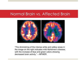Normal Brain vs. Affected Brain “ The diminishing of the intense white and yellow areas in the image on the right indicates mild Alzheimer's disease, with the increase of blue and green colors showing decreased brain activity.” – MFMER 
