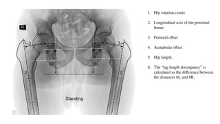 Templating in Total hip arthroplasty.pptx