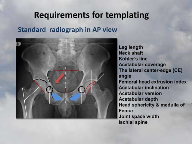 templating-of-total-hip-replacement-thr-ppt