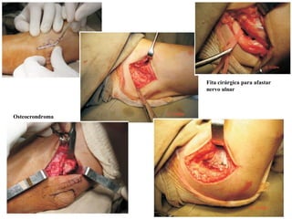 Fita cirúrgica para afastar
nervo ulnar
Osteocrondroma
 