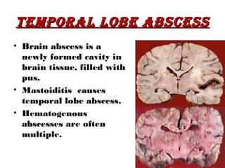 TEMPORAL LOBE ABScESS
• Brain abscess is a
  newly formed cavity in
  brain tissue, filled with
  pus.
• Mastoiditis causes
  temporal lobe abscess.
• Hematogenous
  abscesses are often
  multiple.

                              52
 