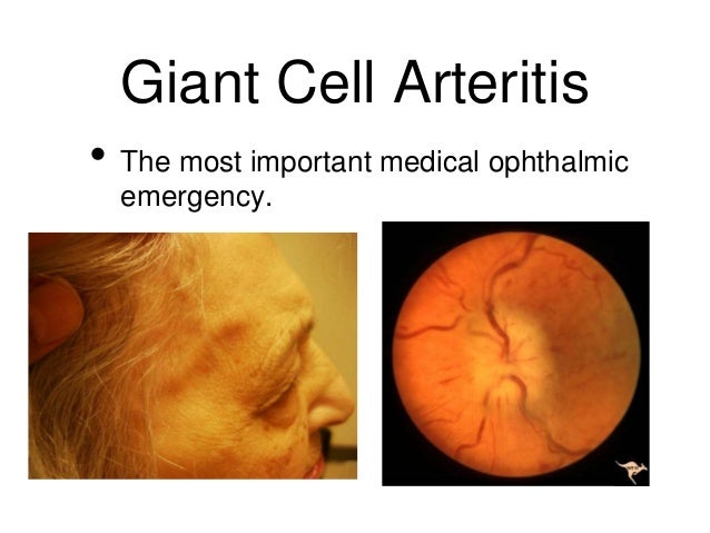 What is temporal arthritis?