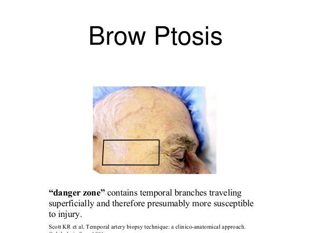 Temporal artery biopsy