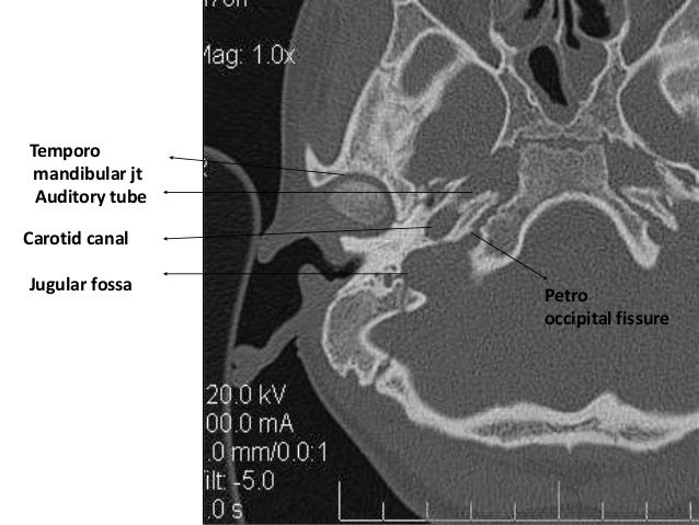 Temporal bone radiology