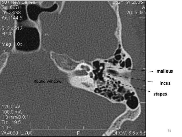 Temporal bone radiology