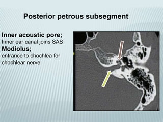 Posterior petrous subsegment
Inner acoustic pore;
Inner ear canal joins SAS
Modiolus;
entrance to chochlea for
chochlear nerve
 