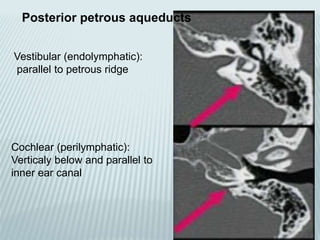 Posterior petrous aqueducts
Vestibular (endolymphatic):
parallel to petrous ridge
Cochlear (perilymphatic):
Verticaly below and parallel to
inner ear canal
 
