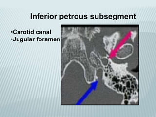 Inferior petrous subsegment
•Carotid canal
•Jugular foramen
 