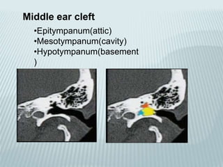 •Epitympanum(attic)
•Mesotympanum(cavity)
•Hypotympanum(basement
)
Middle ear cleft
 