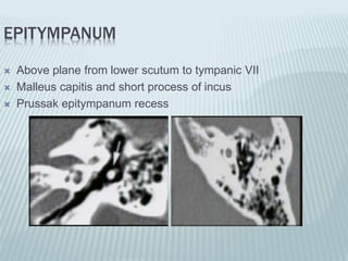 EPITYMPANUM
 Above plane from lower scutum to tympanic VII
 Malleus capitis and short process of incus
 Prussak epitympanum recess
 