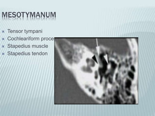 MESOTYMANUM
 Tensor tympani
 Cochleariform process
 Stapedius muscle
 Stapedius tendon
 