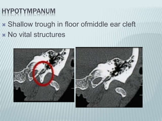 HYPOTYMPANUM
 Shallow trough in floor ofmiddle ear cleft
 No vital structures
 