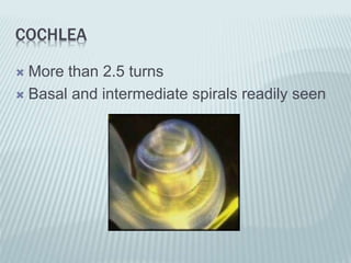 COCHLEA
 More than 2.5 turns
 Basal and intermediate spirals readily seen
 