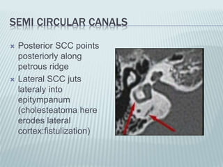 SEMI CIRCULAR CANALS
 Posterior SCC points
posteriorly along
petrous ridge
 Lateral SCC juts
lateraly into
epitympanum
(cholesteatoma here
erodes lateral
cortex:fistulization)
 