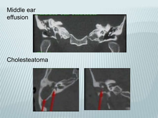 Middle ear
effusion
Cholesteatoma
 