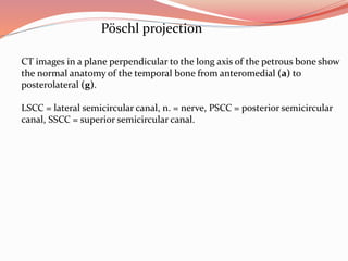 IMAGING OF TEMPORAL BONE | PPTX
