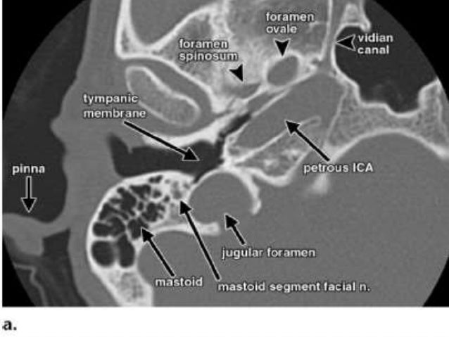 IMAGING OF TEMPORAL BONE