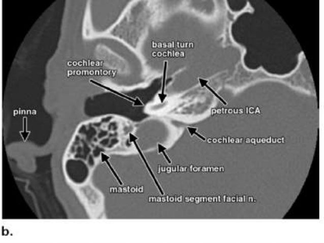 IMAGING OF TEMPORAL BONE