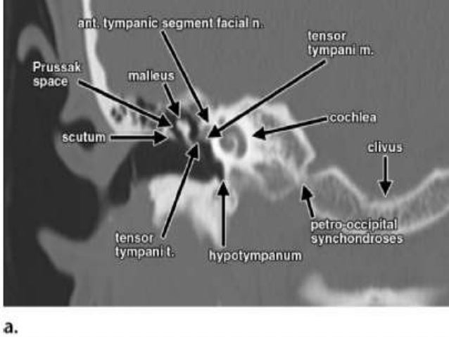 IMAGING OF TEMPORAL BONE