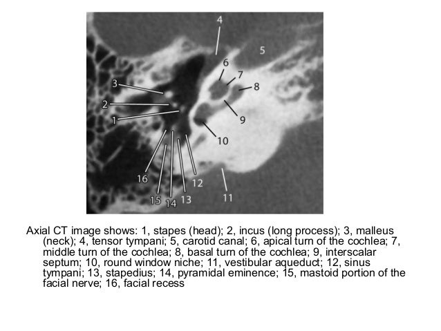 Diagnostic Imaging of Temporal bone
