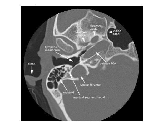 Diagnostic Imaging of Temporal bone