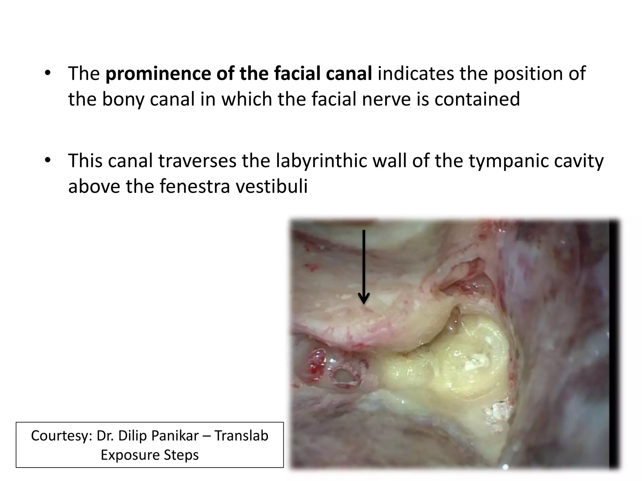 • The prominence of the facial canal indicates the position of
the bony canal in which the facial nerve is contained
• This canal traverses the labyrinthic wall of the tympanic cavity
above the fenestra vestibuli
Courtesy: Dr. Dilip Panikar – Translab
Exposure Steps
 