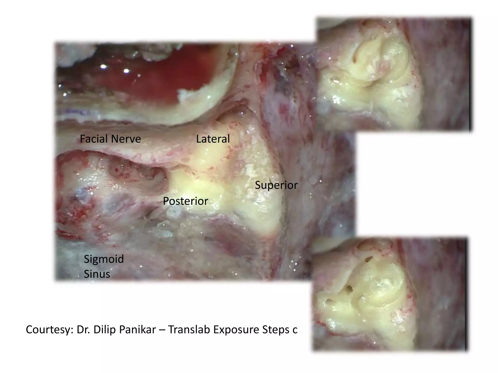 Lateral
Posterior
Superior
Facial Nerve
Sigmoid
Sinus
Courtesy: Dr. Dilip Panikar – Translab Exposure Steps c
 