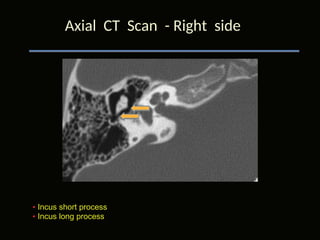 Temporal bone HRCT anatomy.ppt this ppt provides a comprehensive study ...