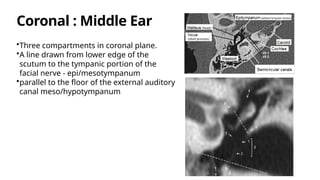 Scutum In Ear HRCT Temporal Bone Anatomy and Imaging Radiology | PPTX