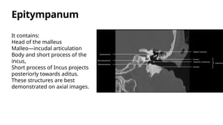 Incus Project HRCT Temporal Bone Anatomy and Imaging Radiology | PPTX