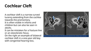 HRCT Temporal Bone Anatomy and Imaging Radiology | PPTX