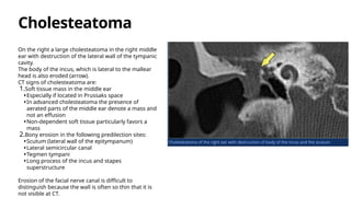 Scutum In Ear HRCT Temporal Bone Anatomy and Imaging Radiology | PPTX