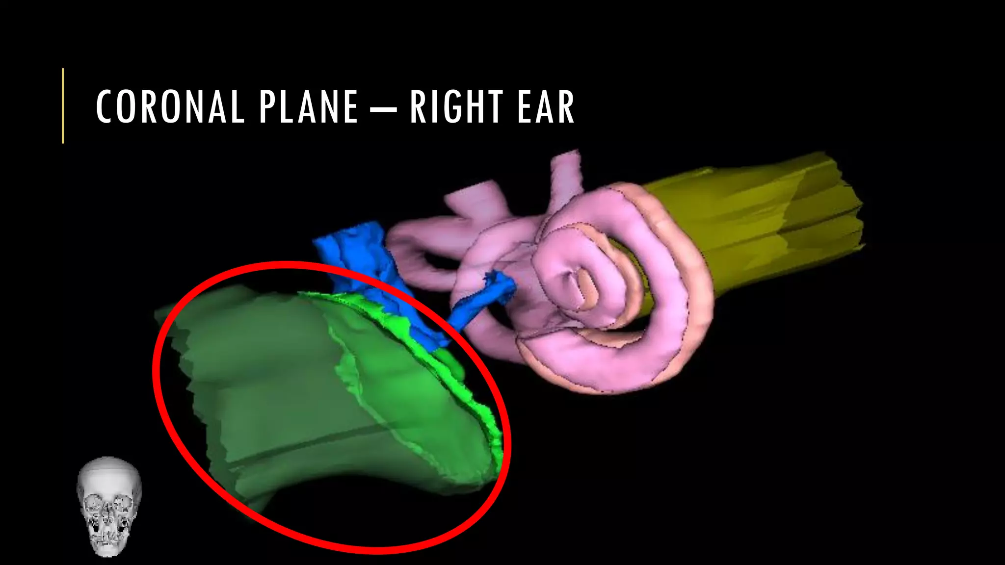 CORONAL PLANE – RIGHT EAR
 