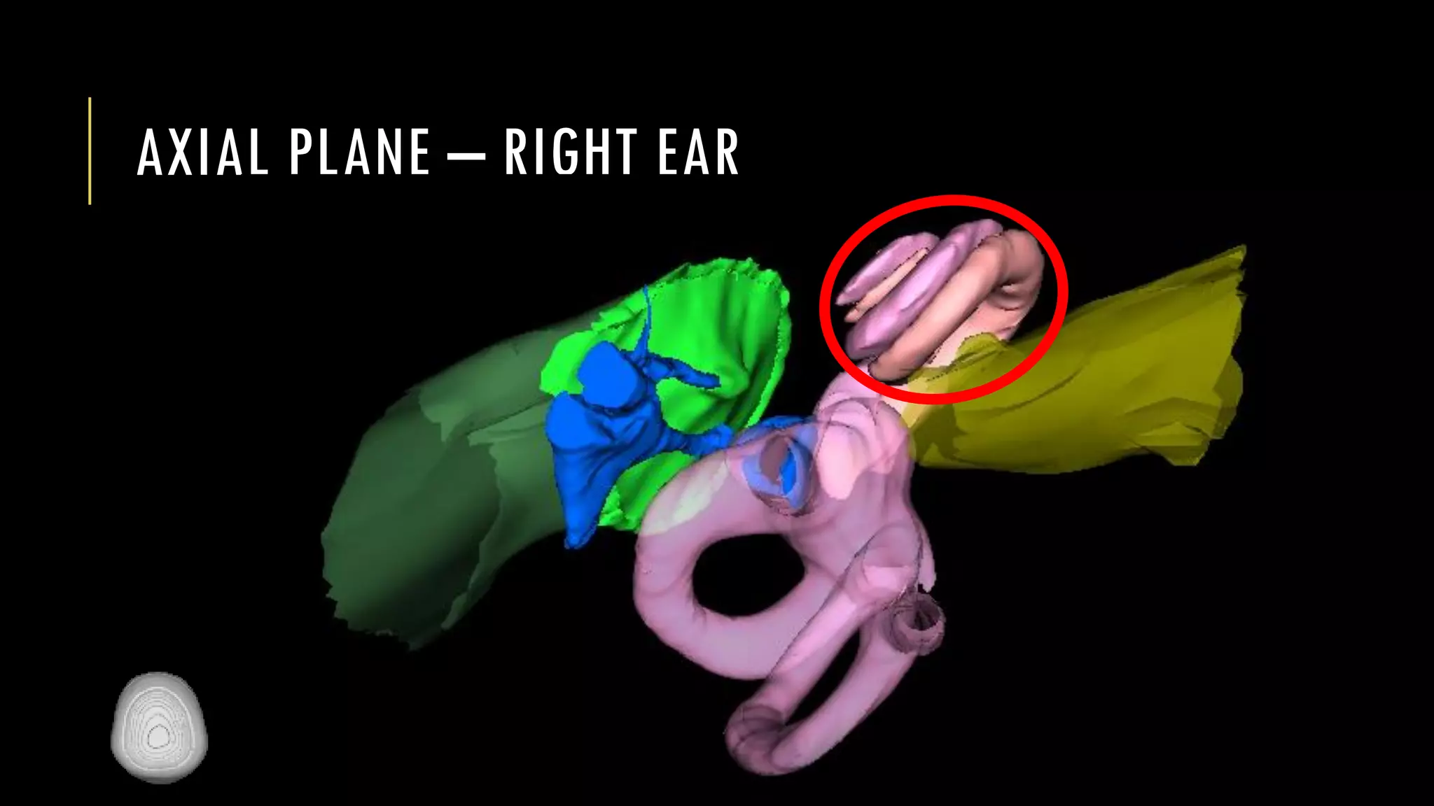 AXIAL PLANE – RIGHT EAR
 