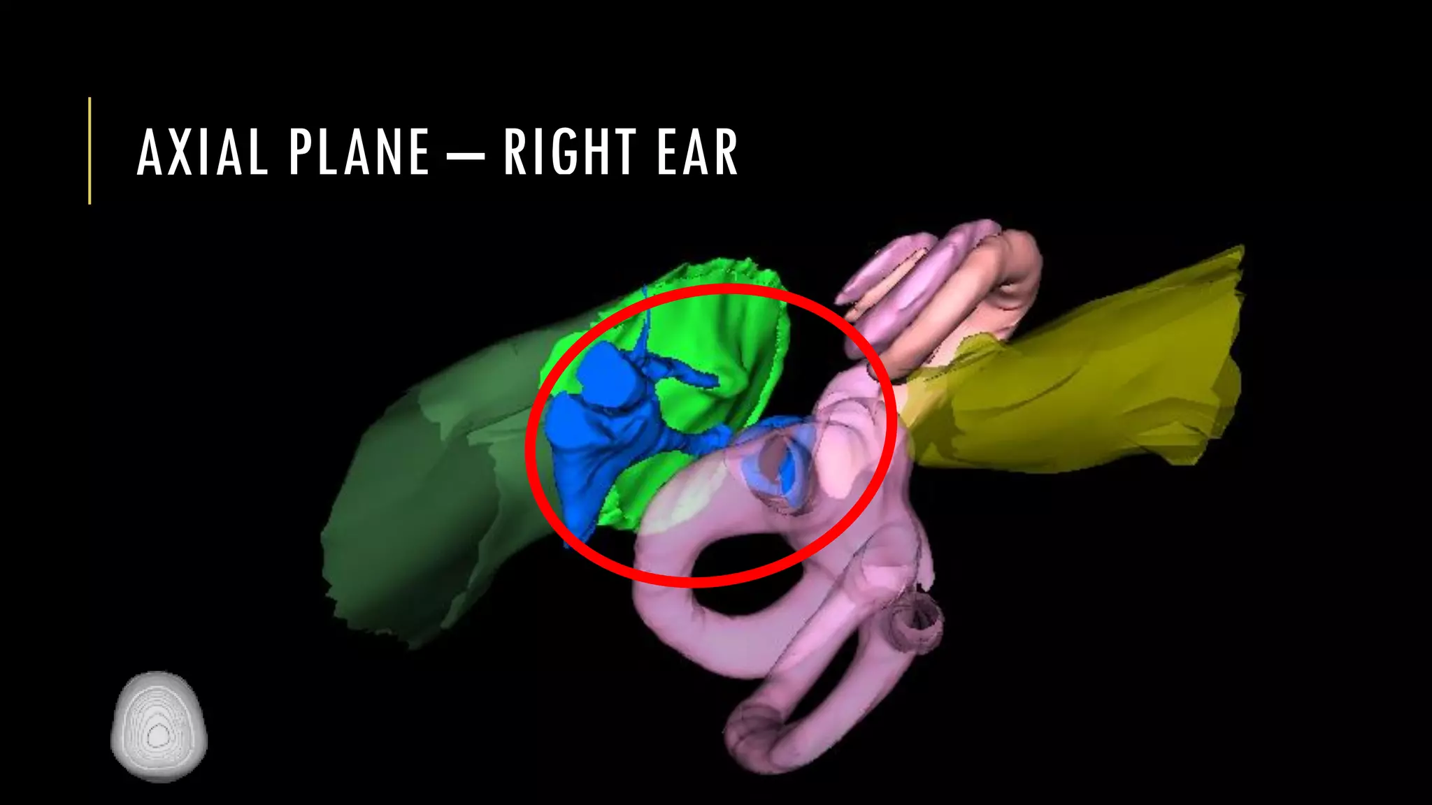 AXIAL PLANE – RIGHT EAR
 