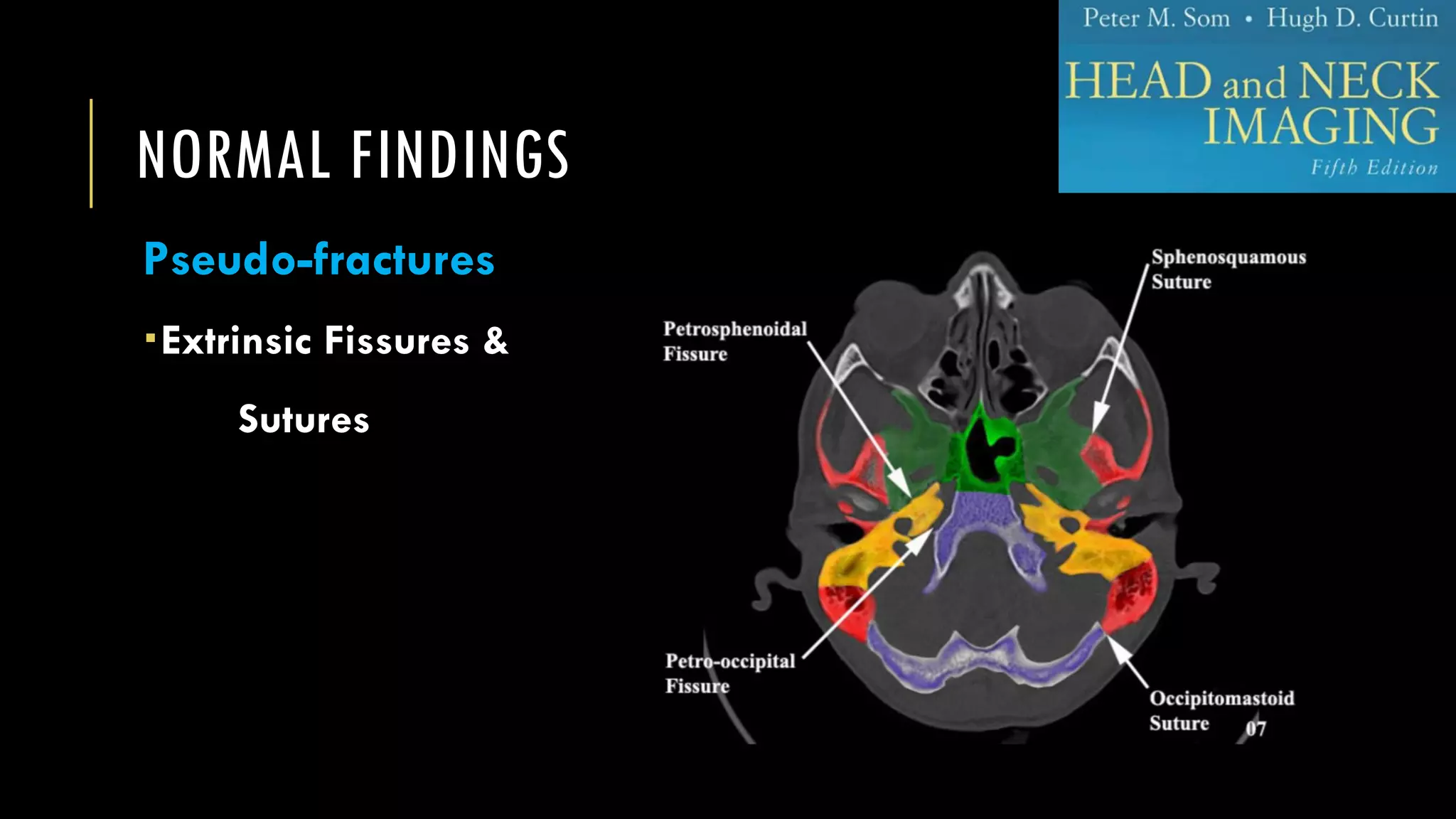 NORMAL FINDINGS
Pseudo-fractures
Extrinsic Fissures &
Sutures
 