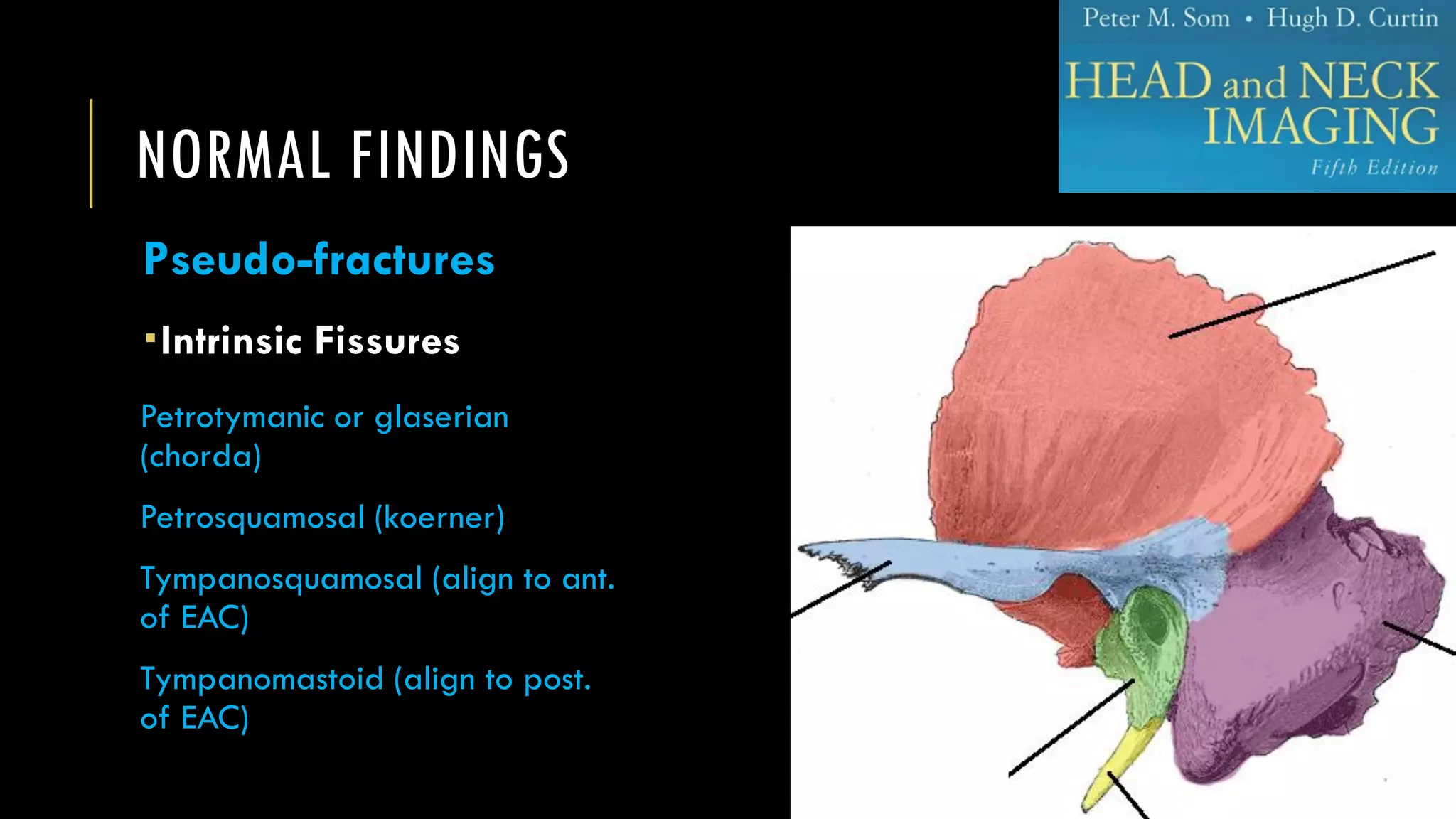 NORMAL FINDINGS
Pseudo-fractures
Intrinsic Fissures
Petrotymanic or glaserian
(chorda)
Petrosquamosal (koerner)
Tympanosquamosal (align to ant.
of EAC)
Tympanomastoid (align to post.
of EAC)
 