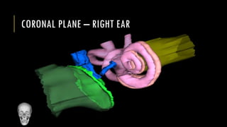 CORONAL PLANE – RIGHT EAR
 