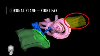 CORONAL PLANE – RIGHT EAR
 