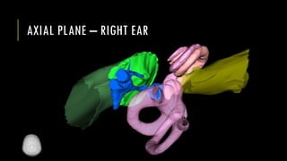 AXIAL PLANE – RIGHT EAR
 