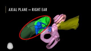 AXIAL PLANE – RIGHT EAR
 