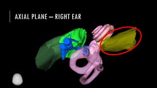 AXIAL PLANE – RIGHT EAR
 
