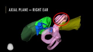 AXIAL PLANE – RIGHT EAR
 