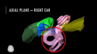AXIAL PLANE – RIGHT EAR
 