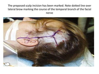 The proposed scalp incision has been marked. Note dotted line over
lateral brow marking the course of the temporal branch of the facial
nerve
A
 